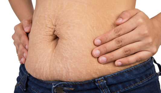 Understanding Stretch Marks: Causes and Effective Treatments